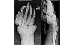 hand injuries